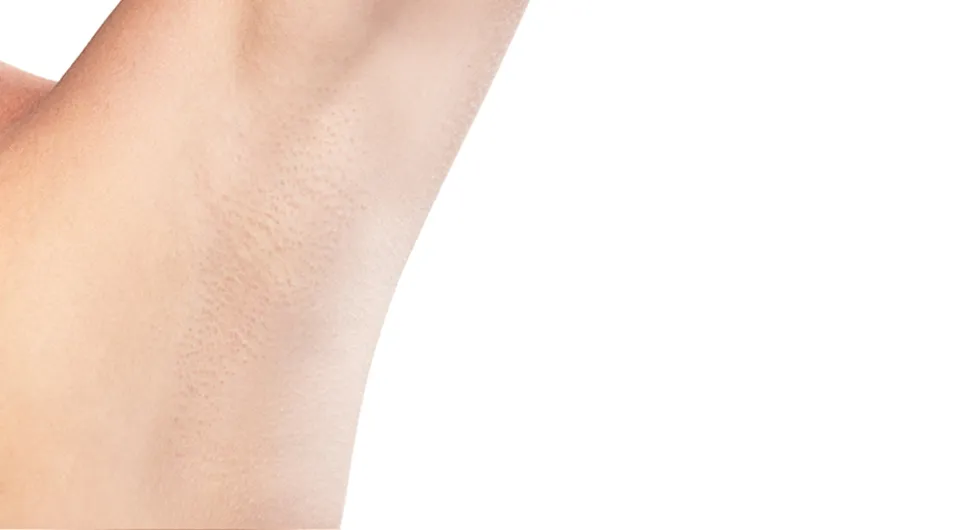 Αποτρίχωση Μασχαλών - Αποτέλεσμα 2 - Μετά